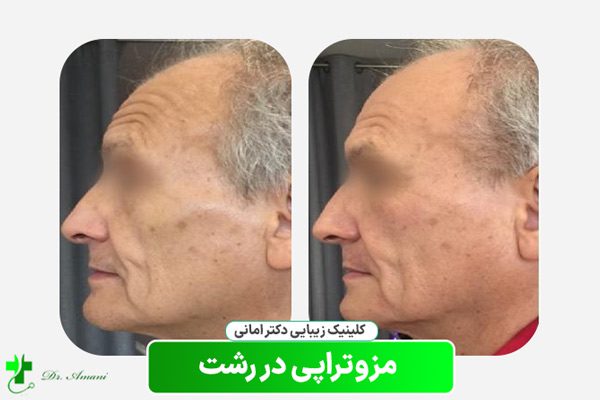 تصویر قبل و بعد مزوتراپی و افراد مناسب برای مزوتراپی صورت