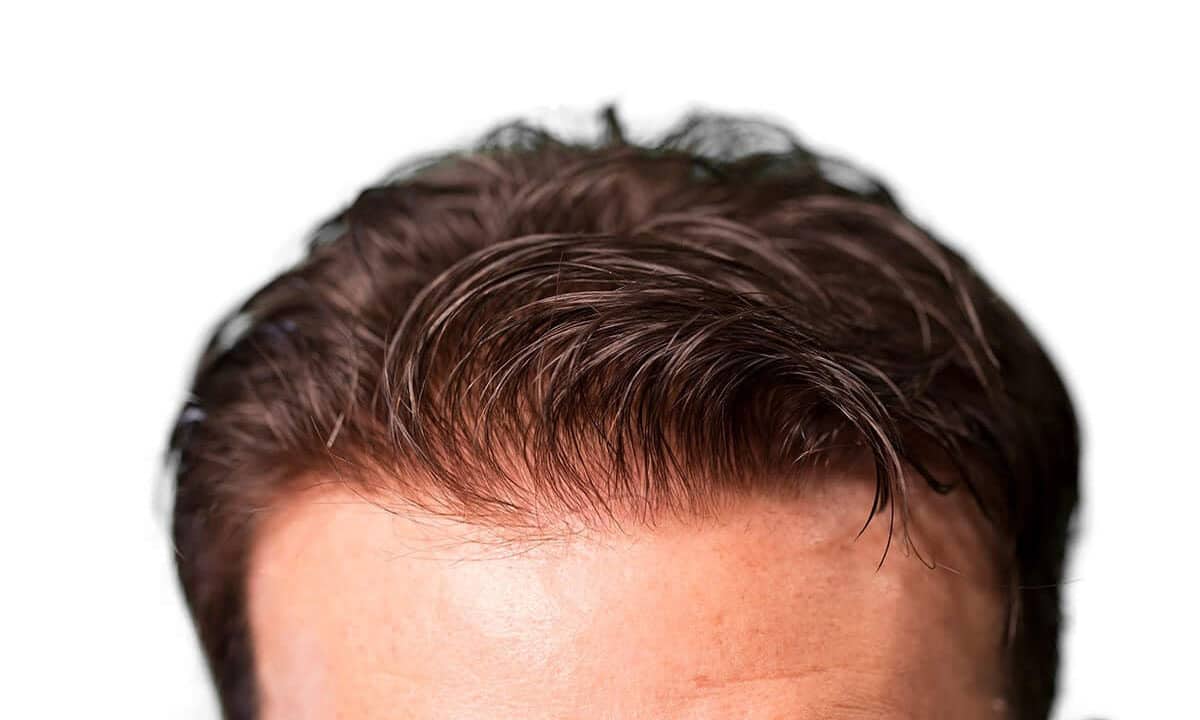 درمان ریزش مو مردان با پی آر پی