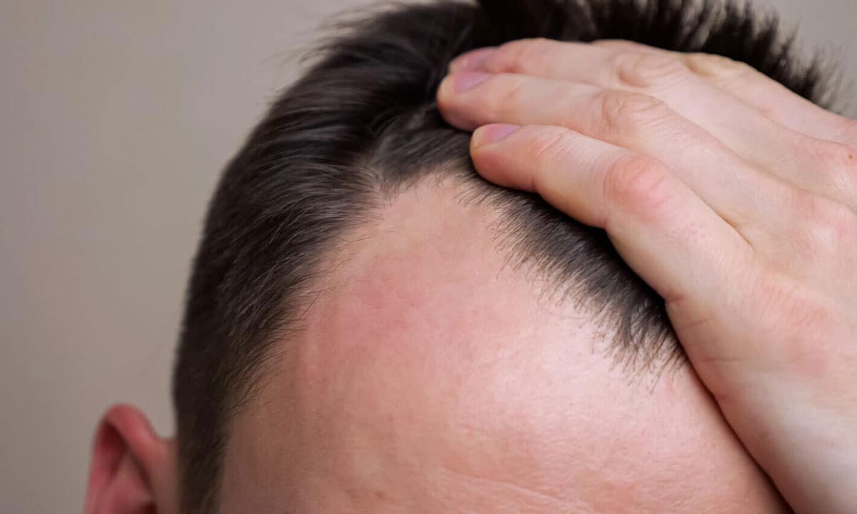 درمان ریزش مو مردان با مزوتراپی