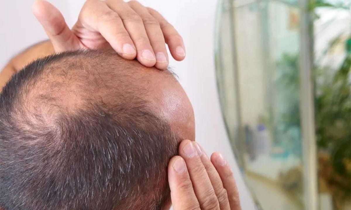 علل و درمان ریزش مو مردان