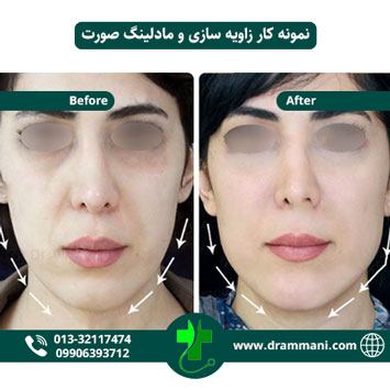 زاویه سازی و مادلینگ صورت دکتر شهروز امانی