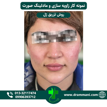 زاویه سازی و مادلینگ صورت دکتر شهروز امانی