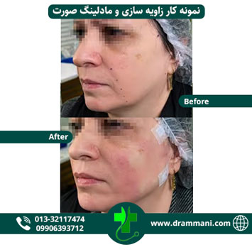 زاویه سازی و مادلینگ صورت دکتر شهروز امانی