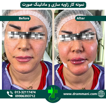 زاویه سازی و مادلینگ صورت دکتر شهروز امانی