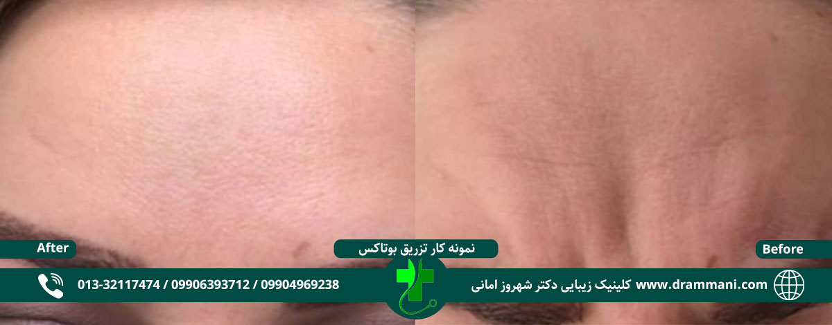 تزریق بوتاکس دکتر امانی رشت