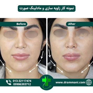 زاویه سازی و مادلینگ صورت دکتر شهروز امانی