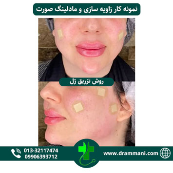 زاویه سازی و مادلینگ صورت دکتر شهروز امانی