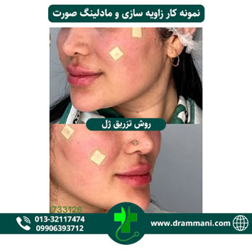 زاویه سازی و مادلینگ صورت دکتر شهروز امانی