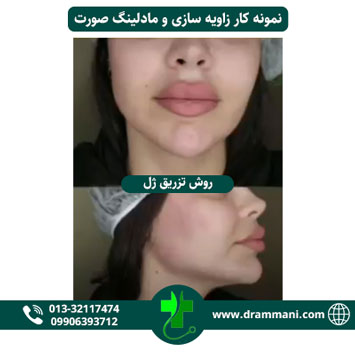 زاویه سازی و مادلینگ صورت دکتر شهروز امانی