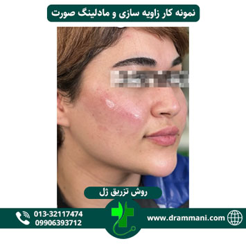 زاویه سازی و مادلینگ صورت دکتر شهروز امانی