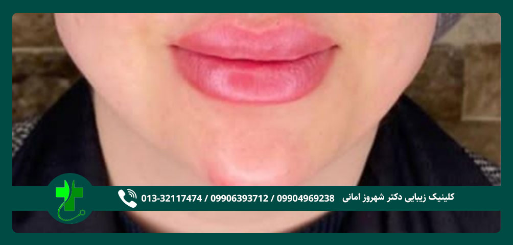 تزریق ژل در رشت