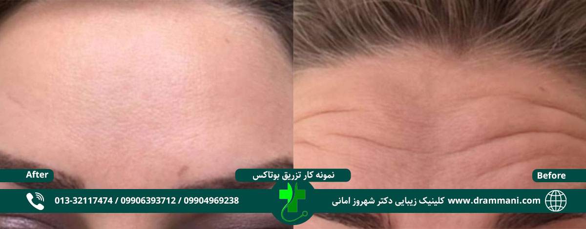 تزریق بوتاکس دکتر امانی رشت