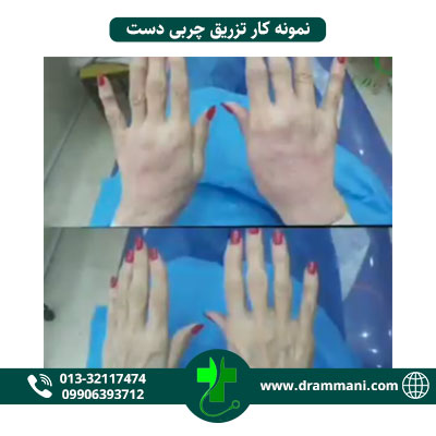 تزریق چربی دست دکتر امانی