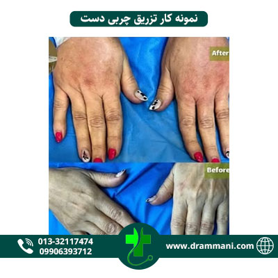 تزریق چربی دست دکتر امانی