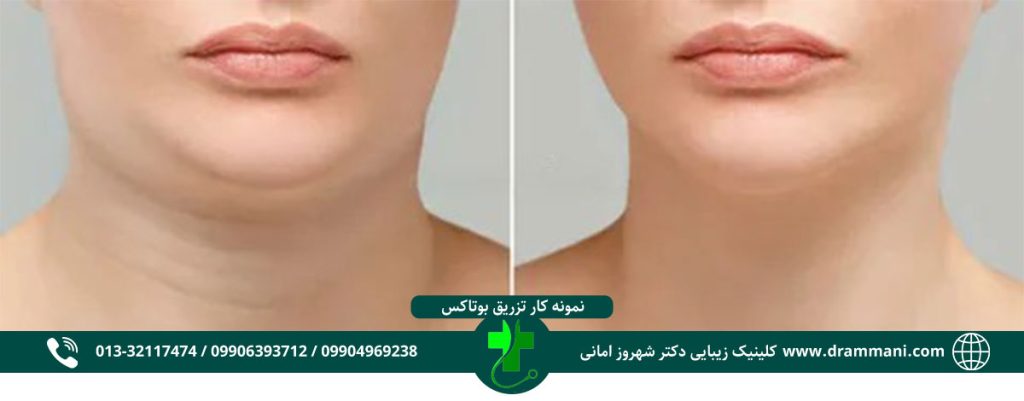 ساکشن غبغب در رشت