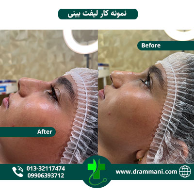 نمونه لیفت بینی دکتر امانی رشت