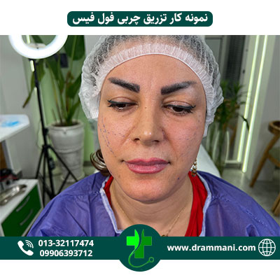 تزریق چربی فول فیس دکتر امانی رشت