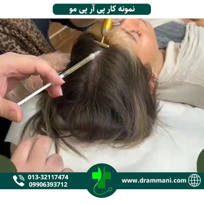 پی آر پی مو در رشت
