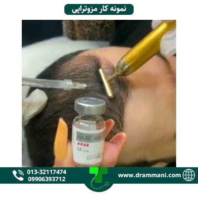 نمونه کار تزریق هیرفیلر در رشت