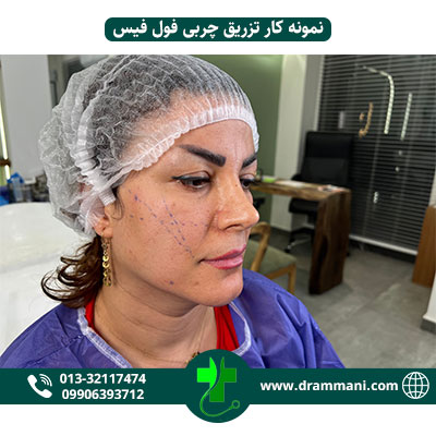 تزریق چربی فول فیس دکتر امانی رشت