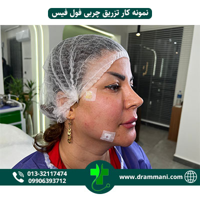 تزریق چربی فول فیس دکتر امانی رشت