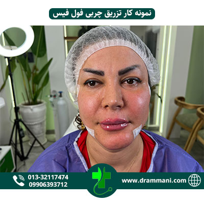 تزریق چربی فول فیس دکتر امانی رشت