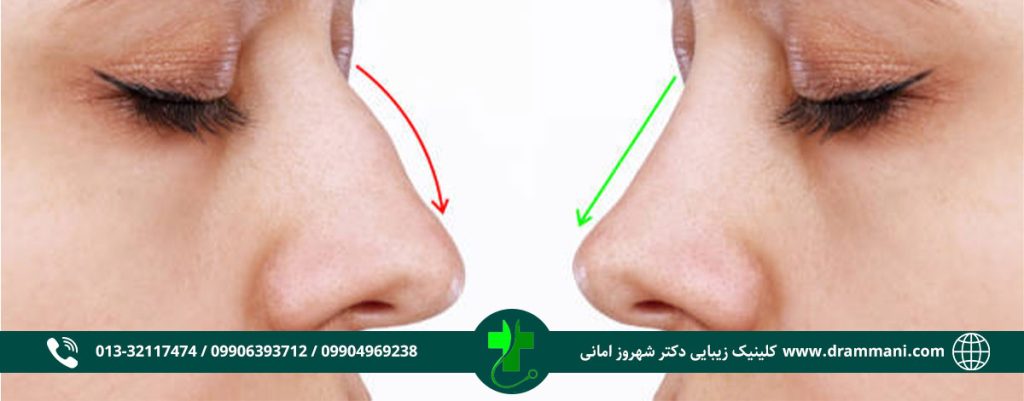 نمونه لیفت بینی دکتر امانی رشت