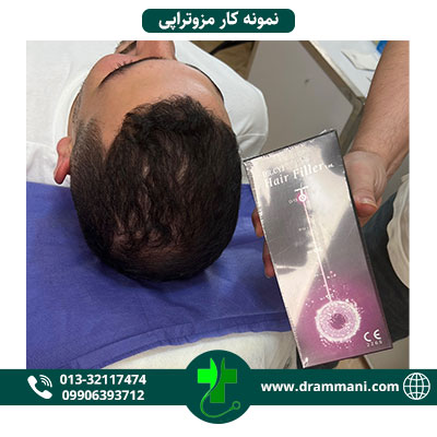 نمونه کار تزریق هیرفیلر در رشت