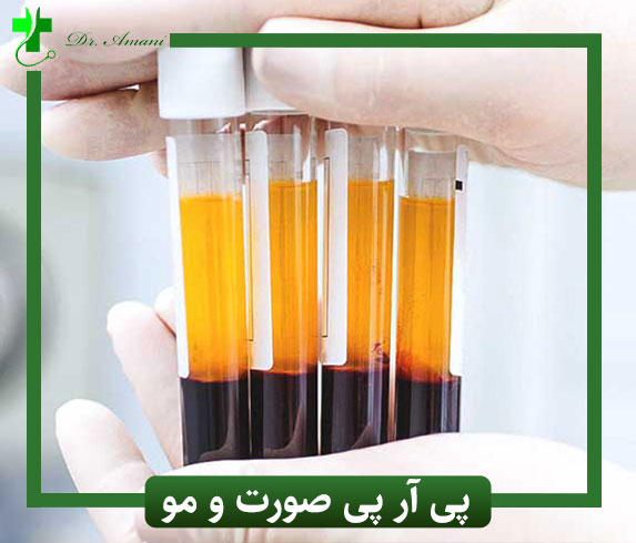پی آر پی مو و صورت در رشت دکتر امانی