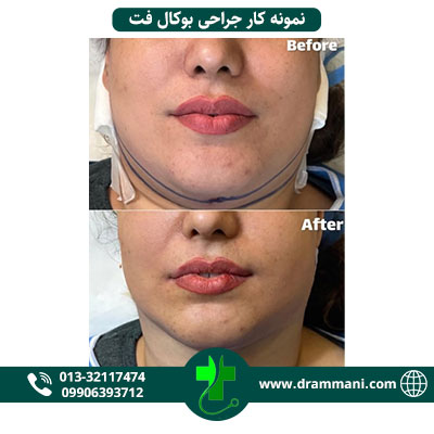 بوکال فت دکتر امانی رشت