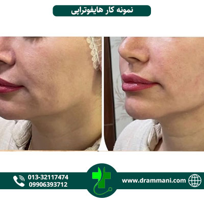 نمونه کار هایفوتراپی دکتر امانی