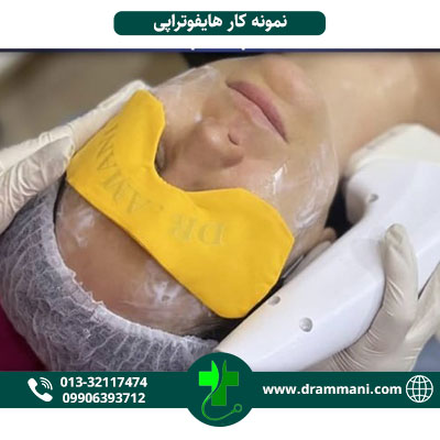 نمونه کار هایفوتراپی دکتر امانی