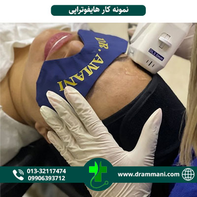 نمونه کار هایفوتراپی دکتر امانی