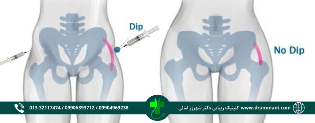 فیلر هیپ دیپ چیست؟